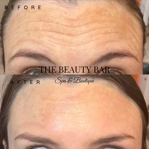 BOTOX BEFORE + AFTER💉
Ready to get wrinkle free for the holidays?! Give us a call to set up your complementary consultation! 
📞 | 225.480.9099
#botox #tox #wrinklefree #skincare #selfcare #botoxinjections #holidayready #botoxcosmetic